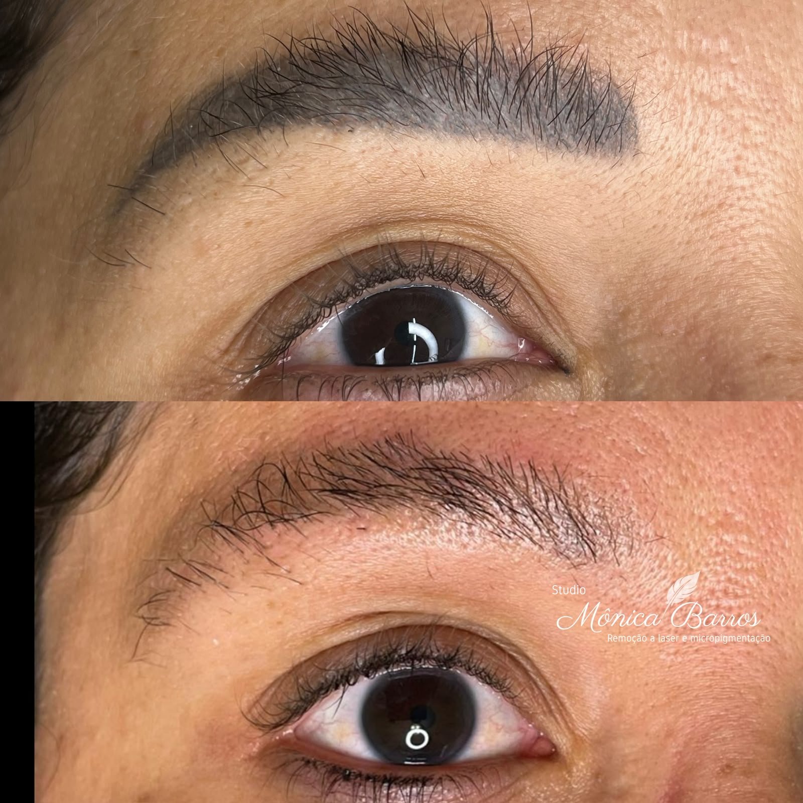 Remoção a Laser Antes e Depois 1