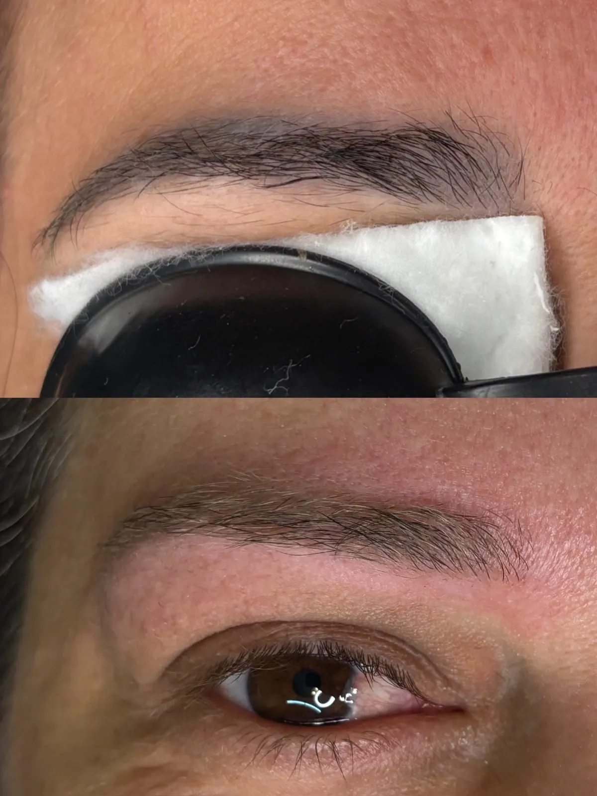 Remoção a Laser Antes e Depois 3